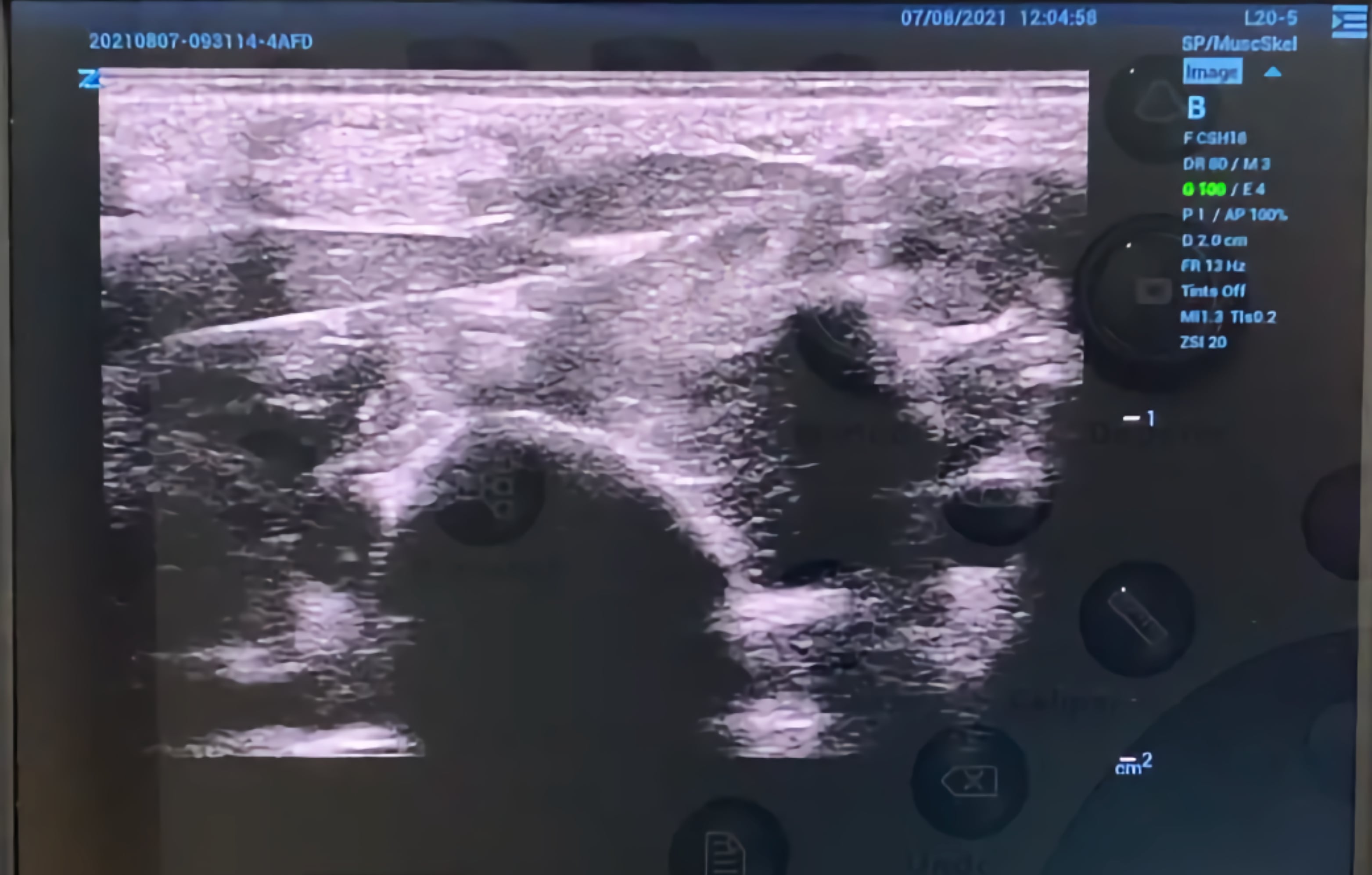 Hip Injection Transverse Approach